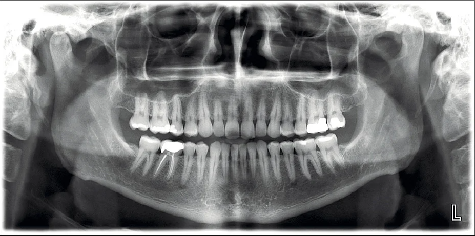 Рентгеновский Снимок Зуба Фото